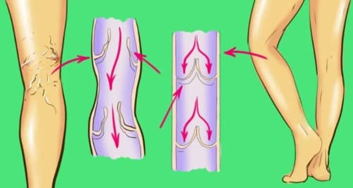 Varicoten medicamento opiniones